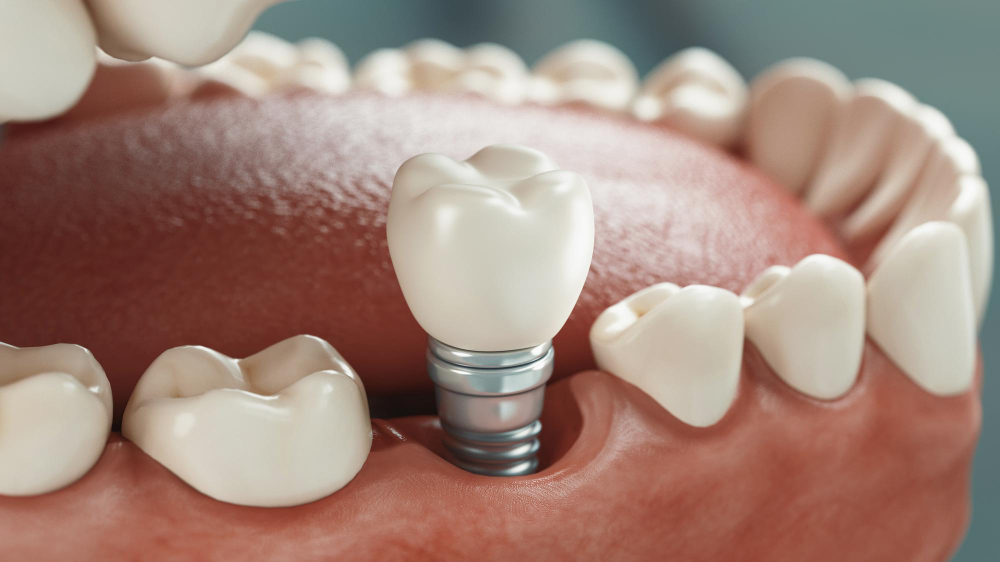 Dental Implants  San Leandro, CA